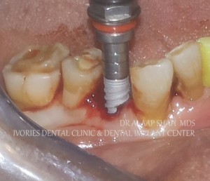 IMMEDIATE IMPLANT PLACEMENT   